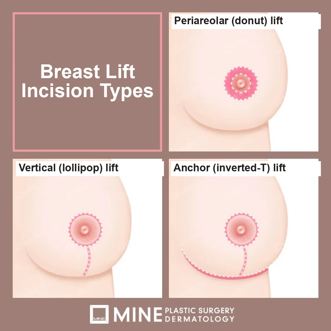 Three breast lift surgery incision patterns compared: periareolar donut, vertical lollipop and anchor inverted-T.