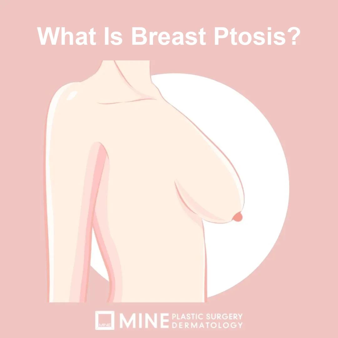 Side-view illustration of a sagging breast showing what breast ptosis looks like before breast lift surgery.