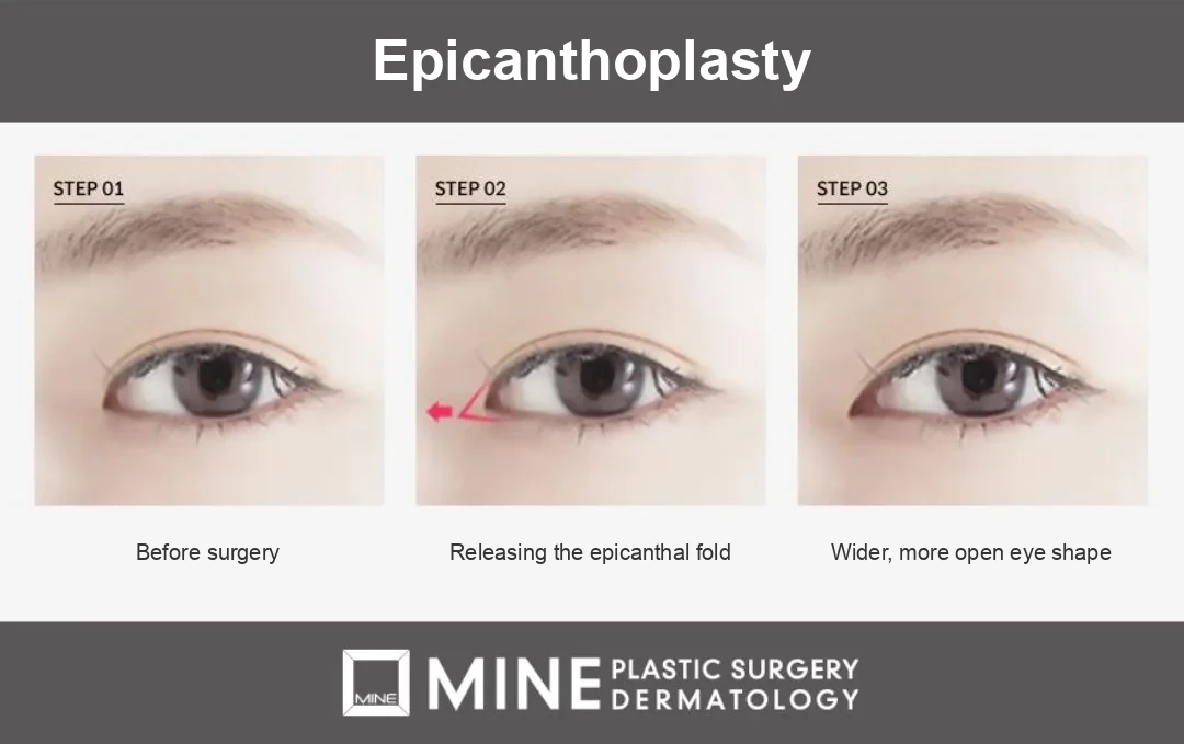 Step-by-step diagram of epicanthoplasty, one of the three types of canthoplasty, releasing the epicanthal fold to widen the inner corner of the eye.