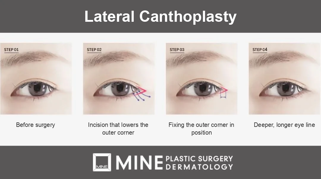Four-step diagram of lateral canthoplasty, one of the main types of canthoplasty, repositioning the outer corner of the eye to extend it horizontally.
