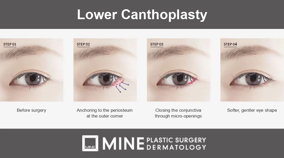 Four-step diagram of lower canthoplasty, one of the types of canthoplasty that lowers the outer-lower lid line to increase the vertical height of the eye.