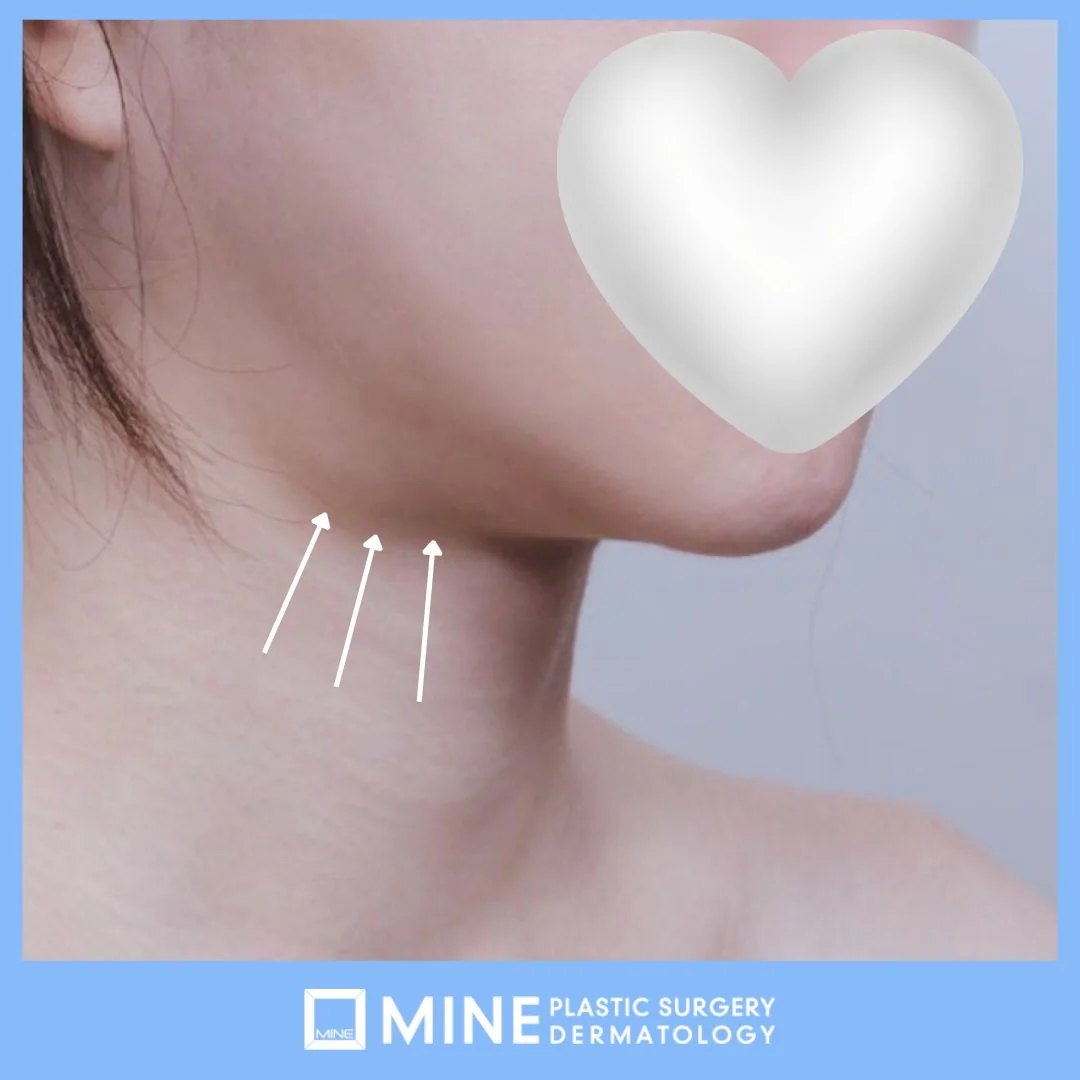 Arrows marking the submandibular gland bulge below the jawline, the finding that drives salivary gland surgery cost in Korea