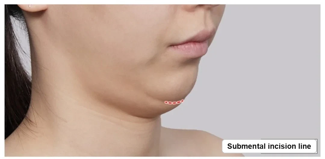 Red dotted line marking the submental incision used to reach the submandibular gland, the surgical approach included in salivary gland surgery cost in Korea