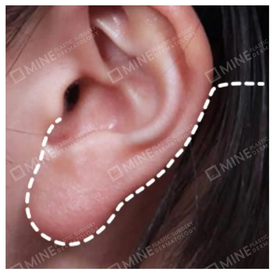Dashed line marking the incision area hidden around and behind the ear in surgical neck lifting procedures