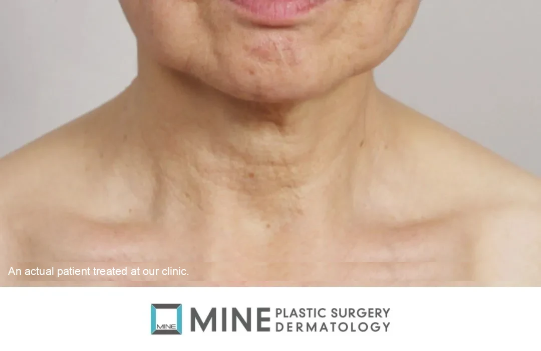 Close-up of a patient’s neck showing skin laxity and horizontal lines, illustrating concerns commonly addressed with a neck lift procedure.