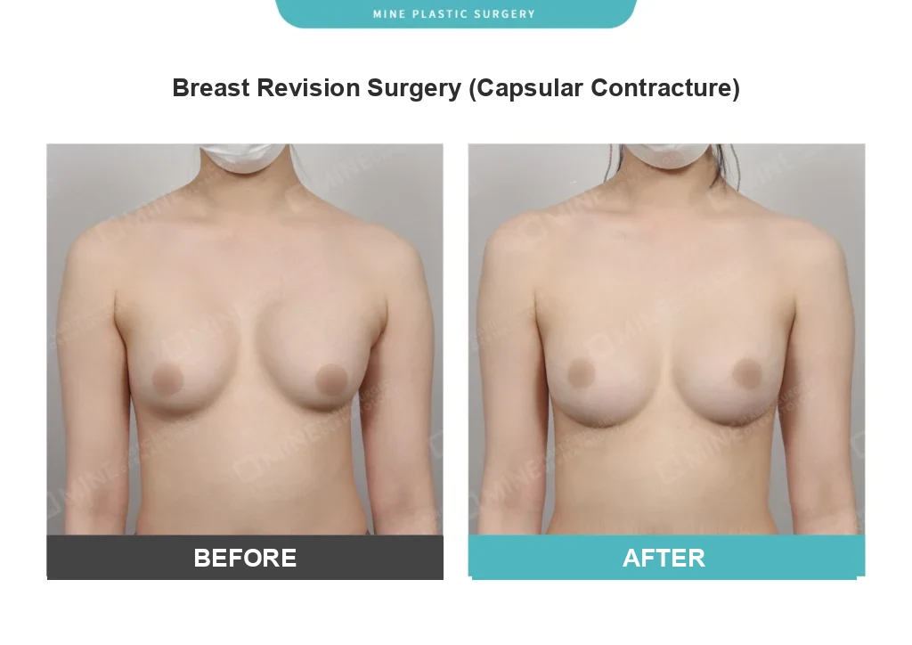 Before and after breast revision surgery at MINE Plastic Surgery for capsular contracture, the same implant exchange approach used when a breast augmentation implant rupture is confirmed.