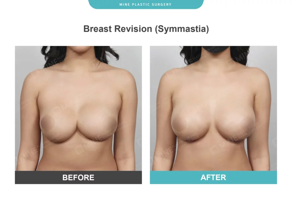 Before and after breast revision surgery at Mine Clinic in Seoul, correcting symmastia so that midline definition between the two breasts is restored.