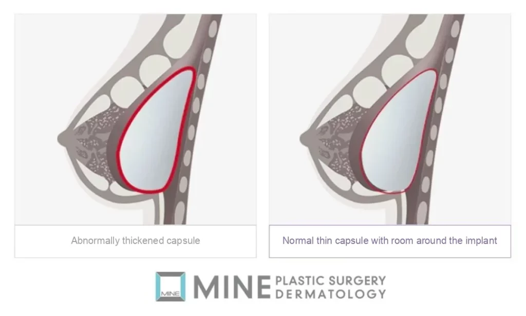 Illustration comparing a normal thin implant capsule with the abnormally thickened capsule seen in capsular contracture.