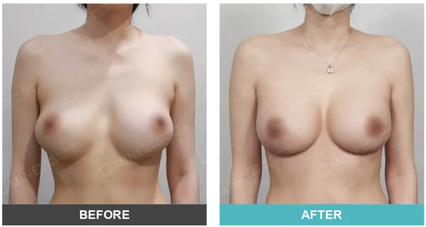 Before and after breast surgery showing improved breast shape after treating capsular contracture, performed at a professional plastic surgery clinic.