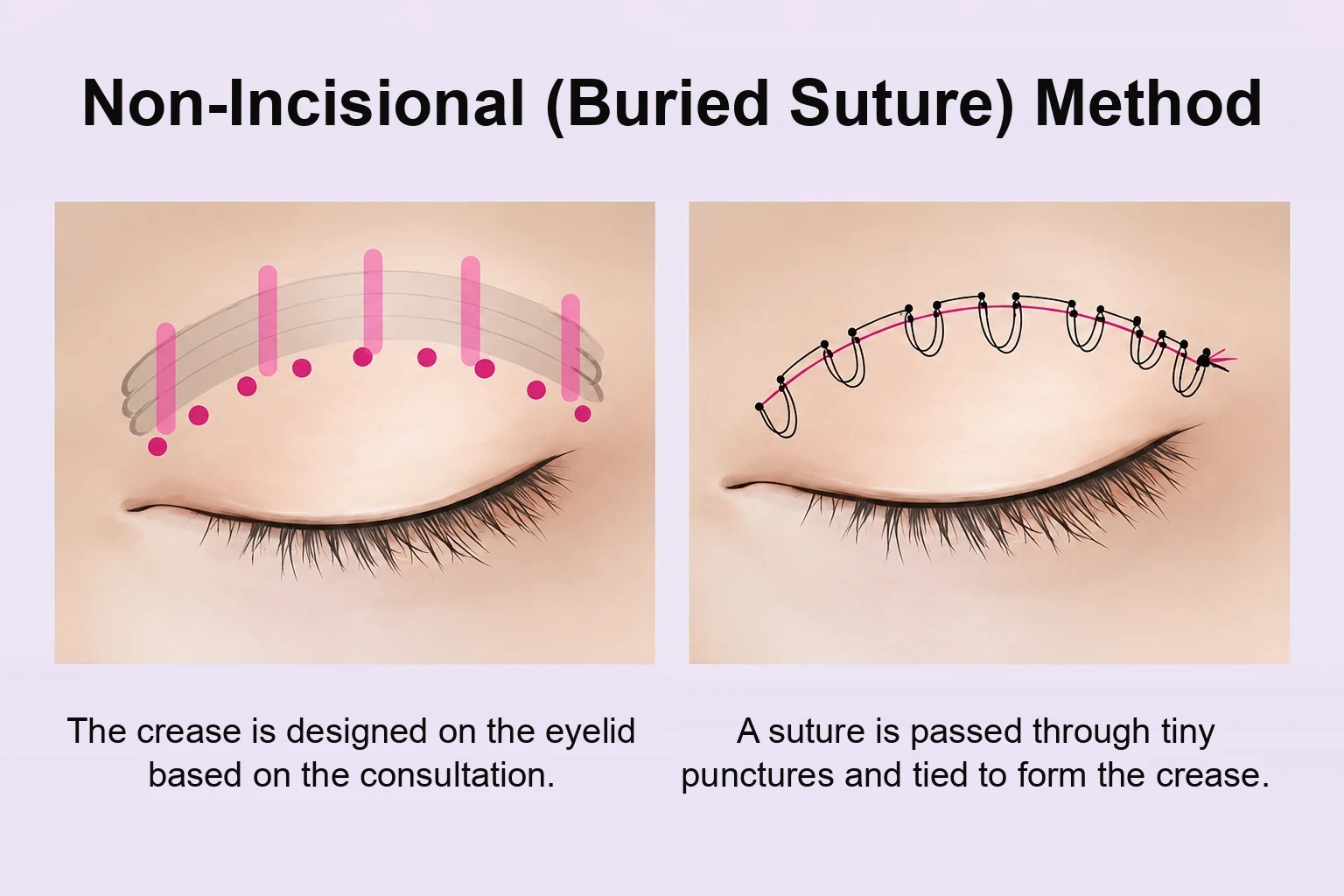 Non-incisional buried suture method, one of the three double eyelid surgery types, shown as a two-panel diagram