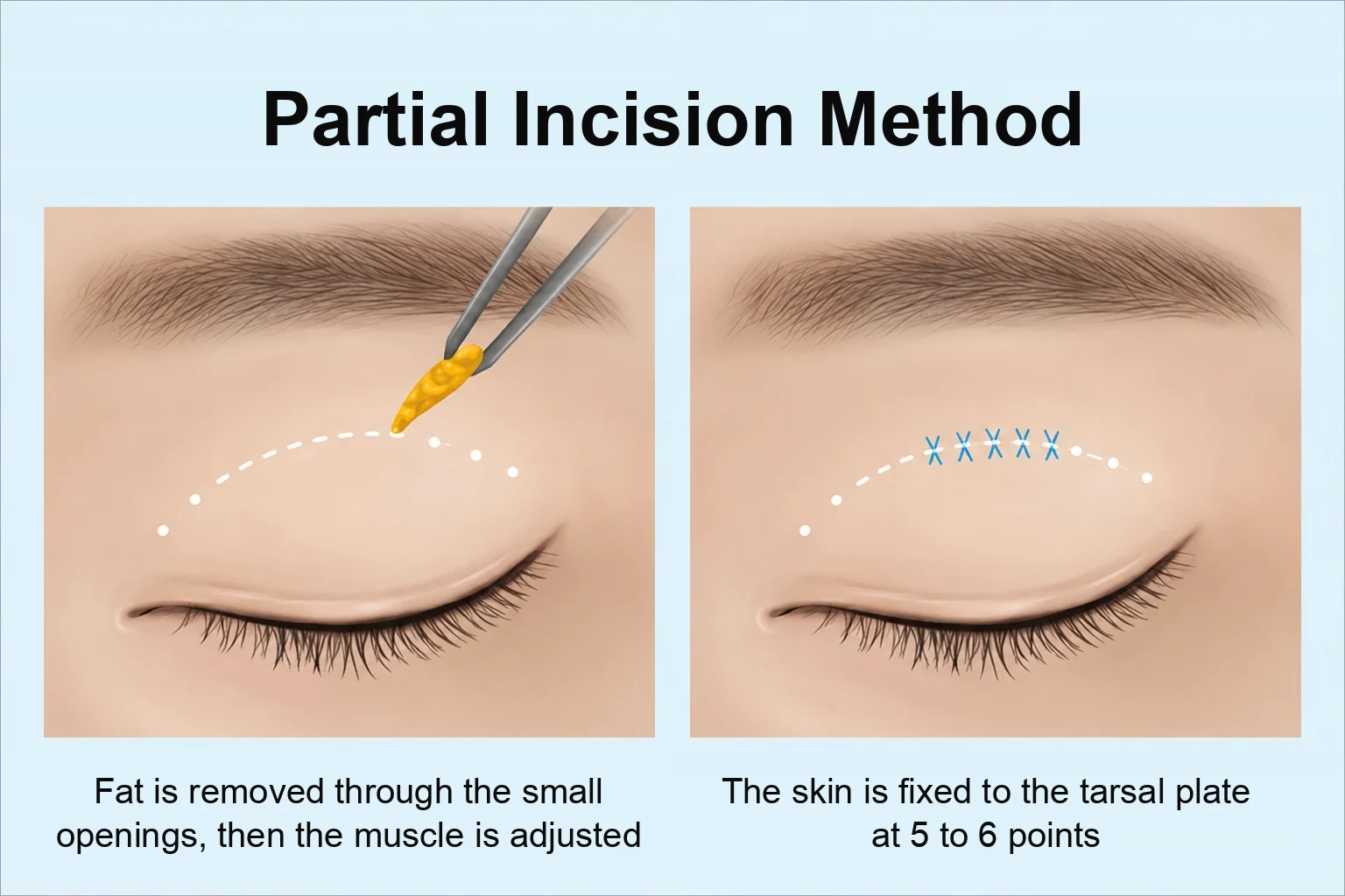 Partial incision method diagram showing small slit incisions and Müller muscle tucking