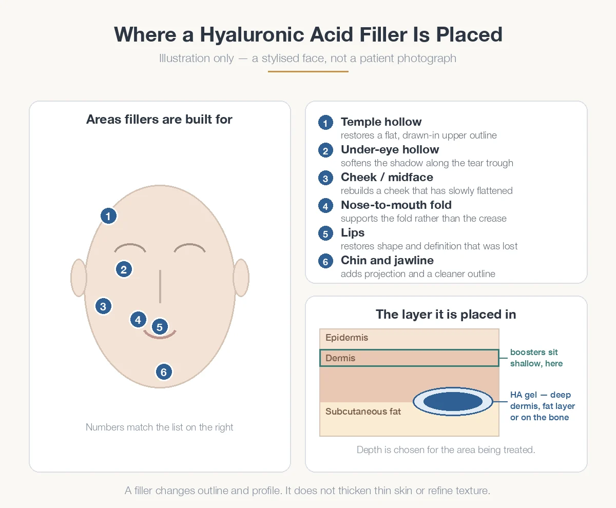 Where hyaluronic acid dermal filler is placed and which facial areas it treats