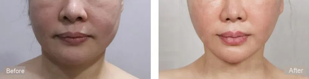 Lower-face and neck photographs labeled Before and After, shown side by side.