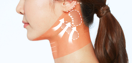 Side-view mini neck lift diagram: the platysma is drawn upward and backward toward the ear, with dashed fixation zones behind the earlobe.