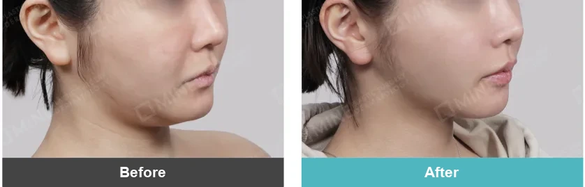 Before and after photos of a mini neck lift, showing a smoother jawline and tighter neck contour after surgery