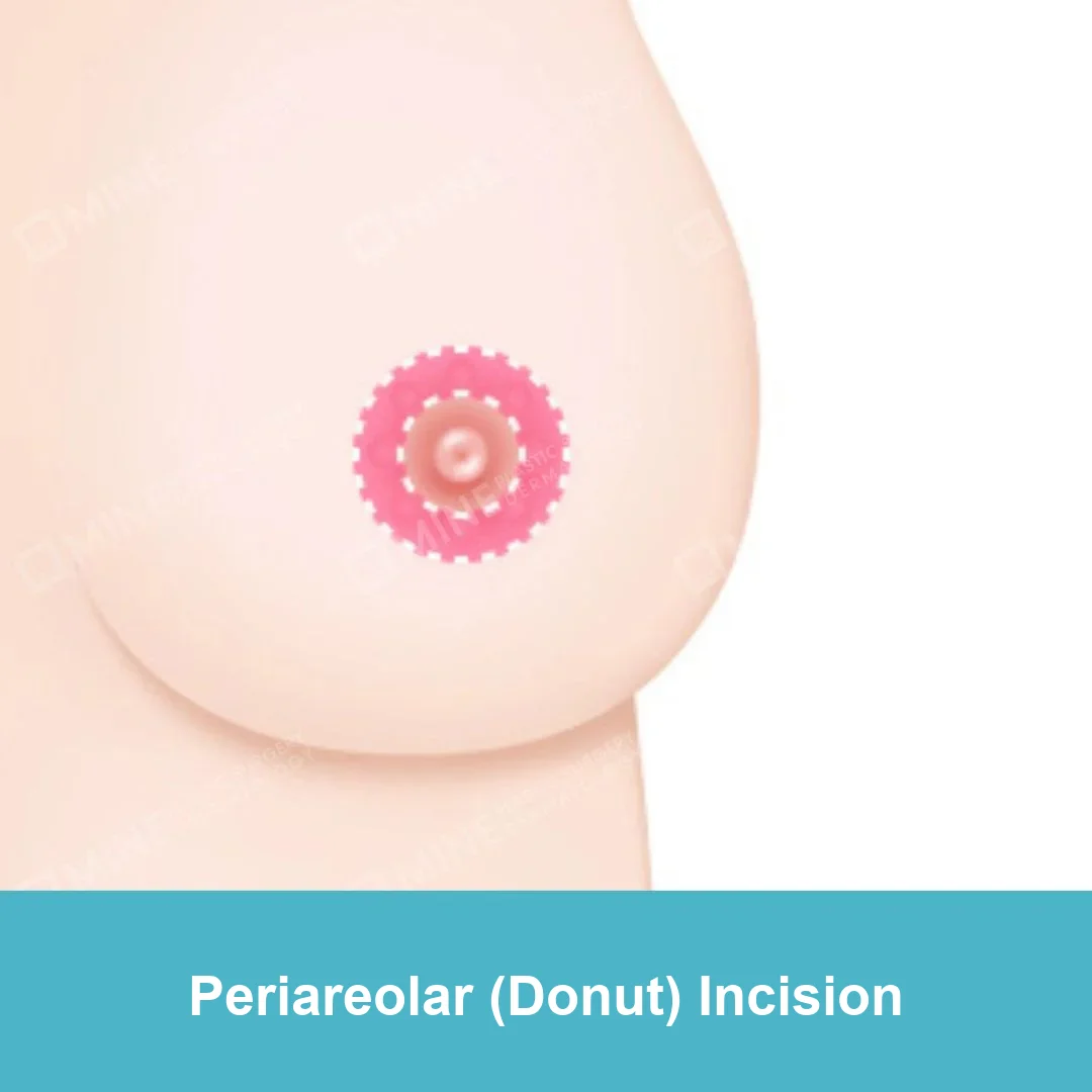 Diagram of the periareolar (donut) incision for breast reduction surgery, placed only around the areola
