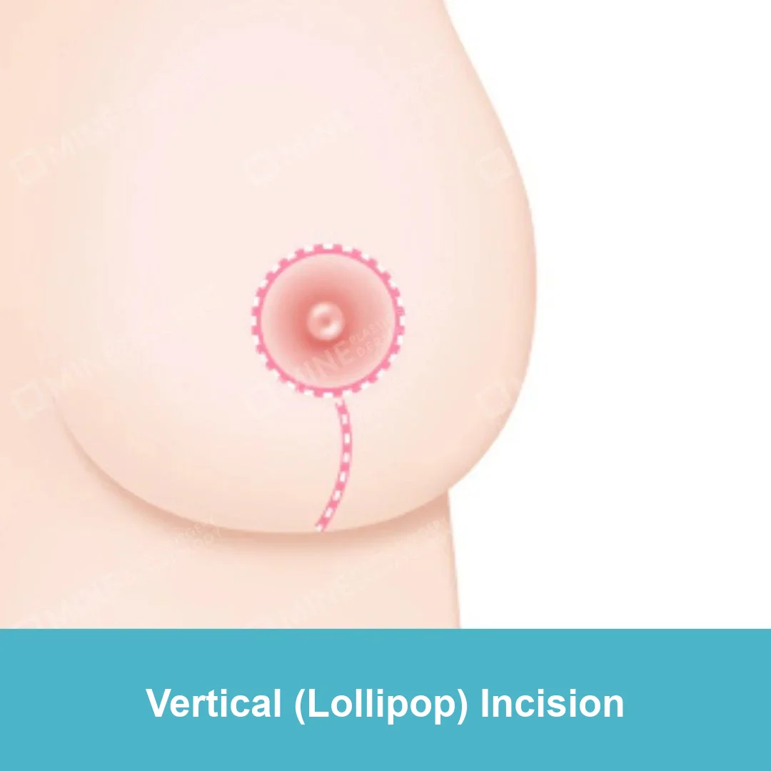 Diagram of the vertical (lollipop) incision for breast reduction surgery: around the areola and straight down to the breast crease