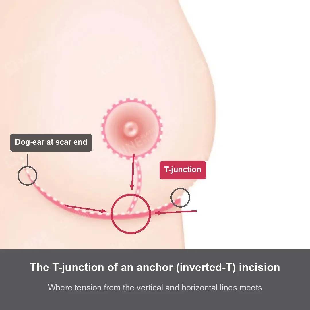 Illustration of the T-junction and scar-end dog-ears in anchor lift scars where vertical and horizontal tension meets