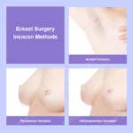 Breast augmentation incision location comparison: armpit, periareolar and inframammary incision sites
