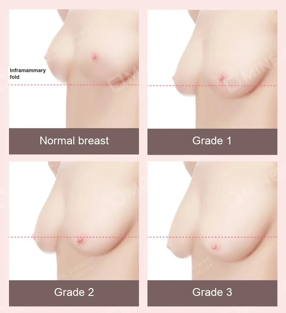 Side-view illustration of normal breast and grade 1 to 3 breast sagging relative to the inframammary fold
