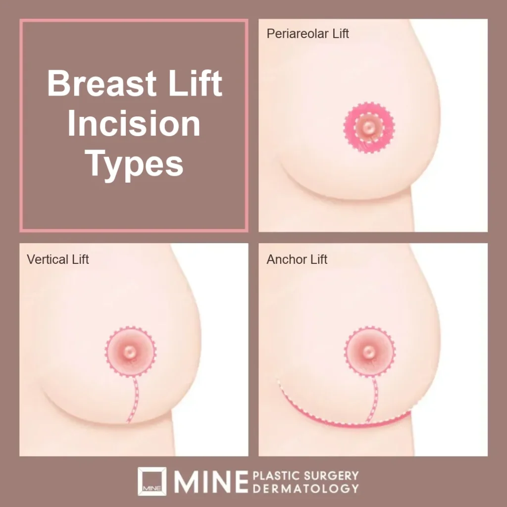 Breast lift scar timeline illustration comparing periareolar, vertical and anchor incision lines