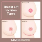 Breast lift scar timeline illustration comparing periareolar, vertical and anchor incision lines