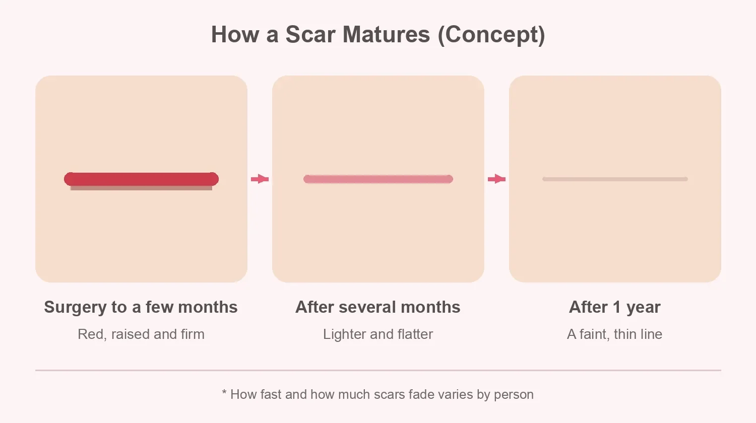 Concept diagram of a breast lift scar timeline from red and raised to lighter and flatter to a faint line after one year