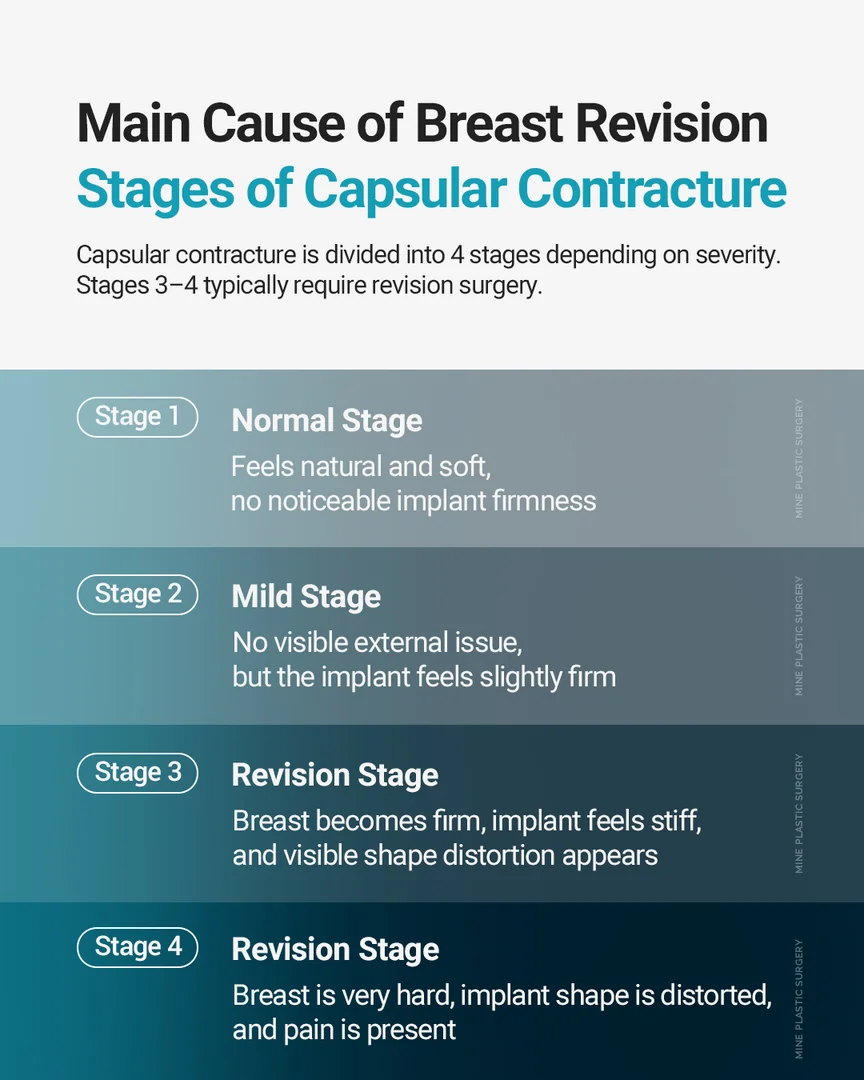 Four stages of capsular contracture, a leading reason women seek breast implant revision after surgery abroad