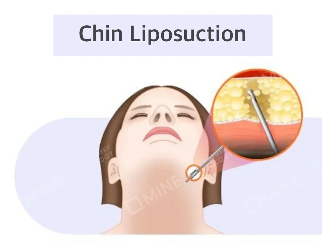 Illustration of chin liposuction: a thin cannula inserted under the jaw removes subcutaneous fat