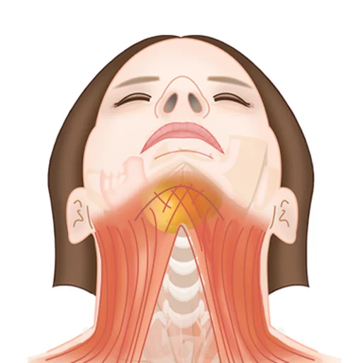 Illustration of the platysma neck muscle bands and the fat pad under the chin, structures double chin exercises alone cannot tighten