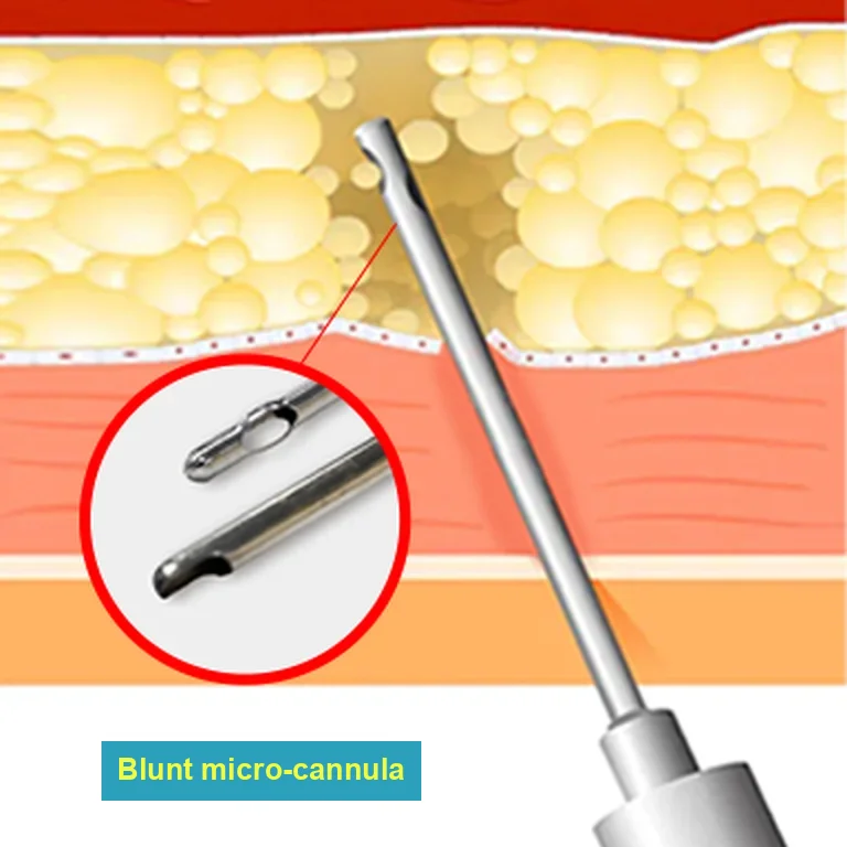 Double chin surgery side effects such as lumpiness: cross-section illustration of the under-chin fat layer with a blunt micro-cannula