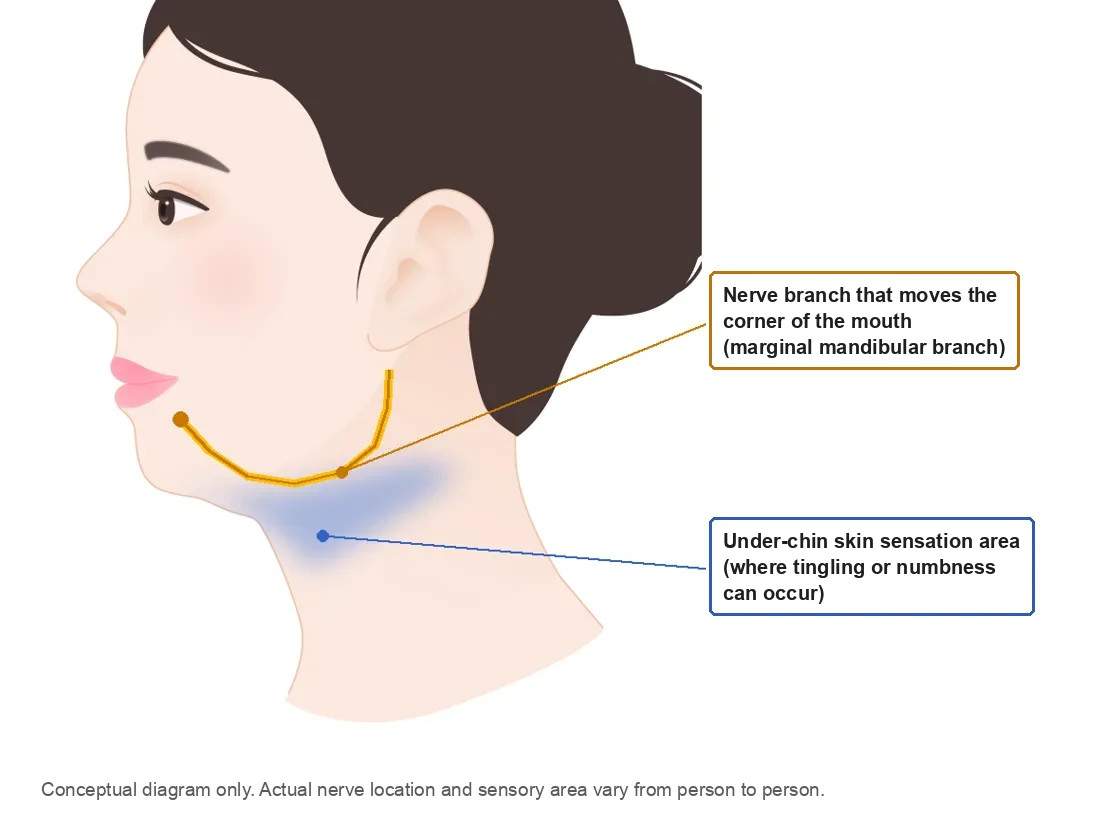 Double chin surgery side effects involving nerves: diagram of the marginal mandibular nerve branch along the jawline and the under-chin skin sensation area