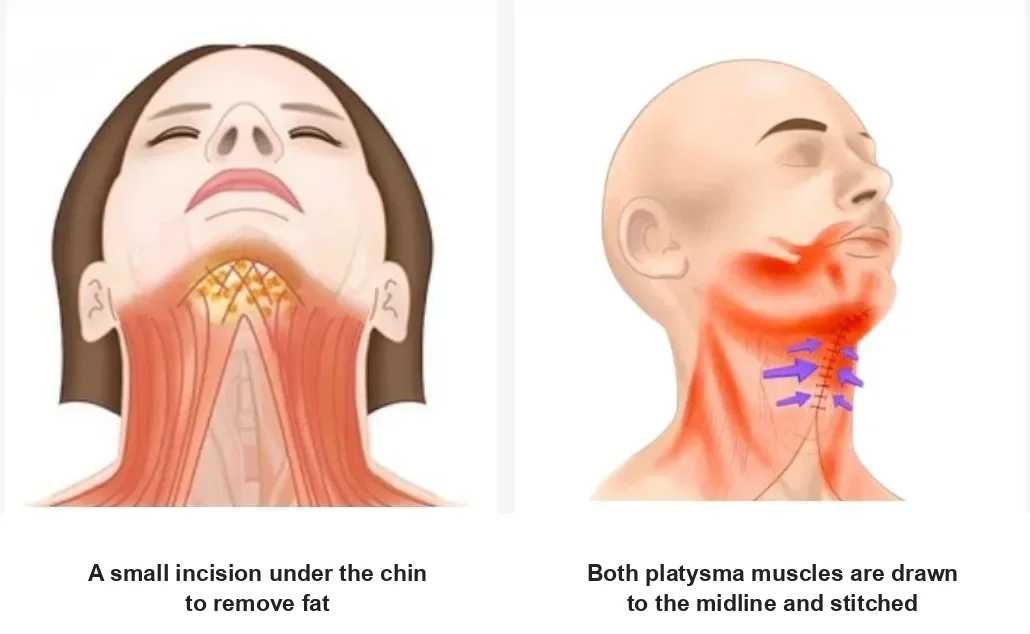 Double chin surgery side effects explained: illustration of fat removed through a small under-chin incision and the platysma muscles stitched at the midline