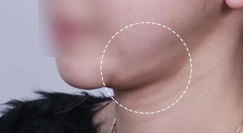 Double chin surgery side effects area guide: side view with a dotted circle marking the under-chin and upper neck where swelling or a lump may be felt