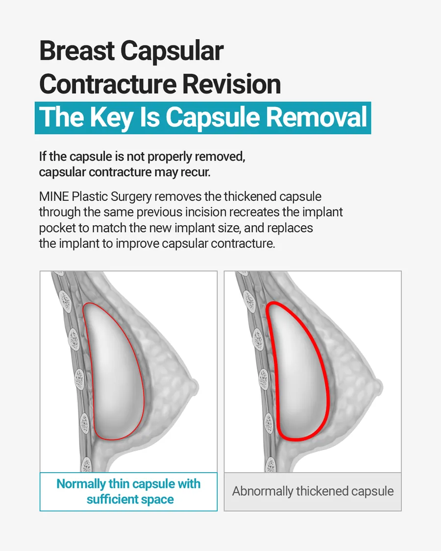 Illustration comparing a normal thin capsule with a thickened capsule around a breast implant