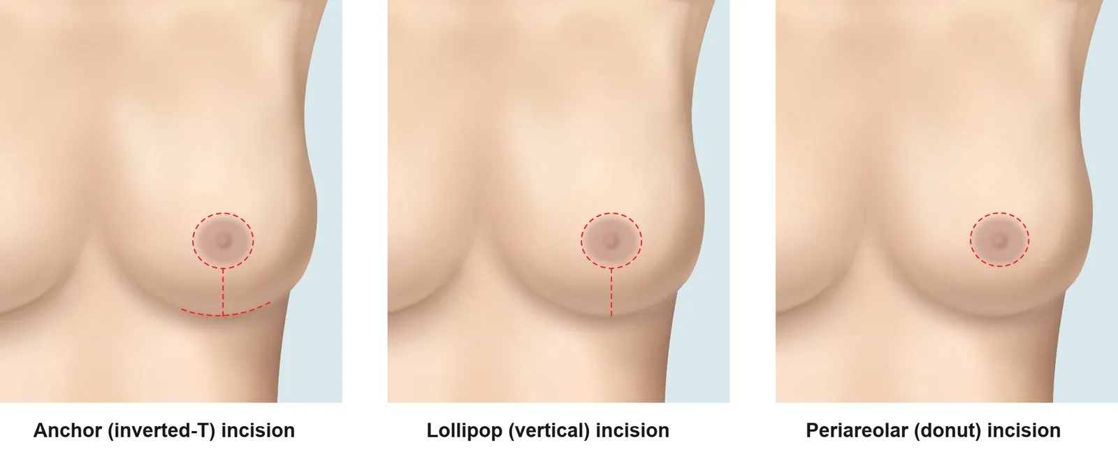 Breast lift incision options when downsizing breast implants with a lift: anchor, lollipop and periareolar incisions