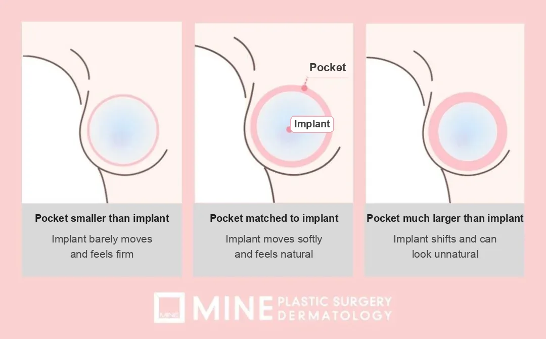 Diagram of implant pocket fit: after downsizing breast implants, a pocket much larger than the implant lets it shift