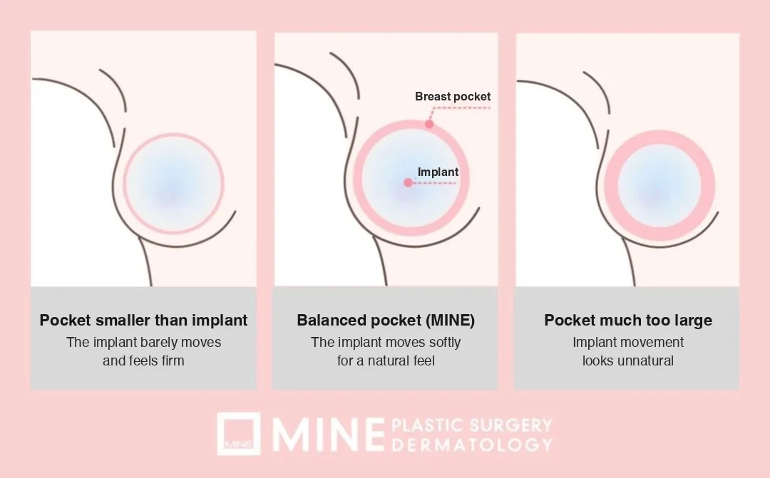 Diagram for endoscopic breast augmentation comparing a pocket smaller than the implant, a balanced pocket and a pocket much too large