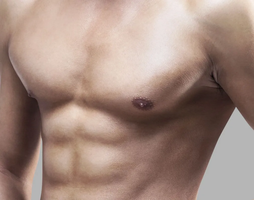 Gynecomastia surgery scars guide — front view of a lean male chest