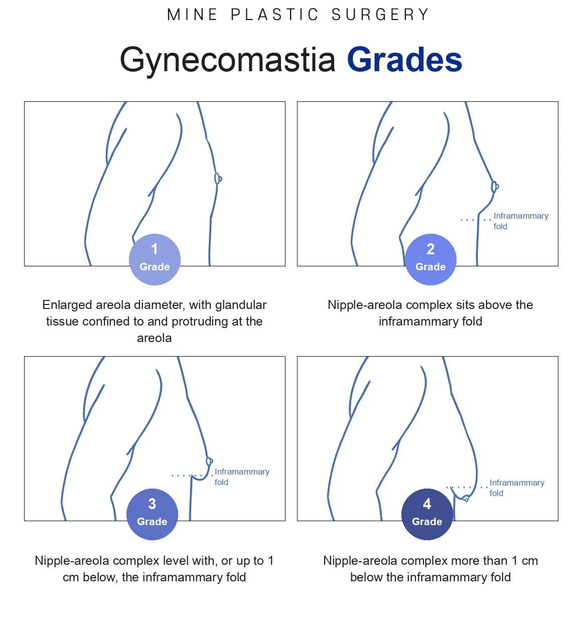 MINE Plastic Surgery diagram grading gynecomastia 1 to 4 by nipple-areola position, which helps predict the extent of gynecomastia surgery scars