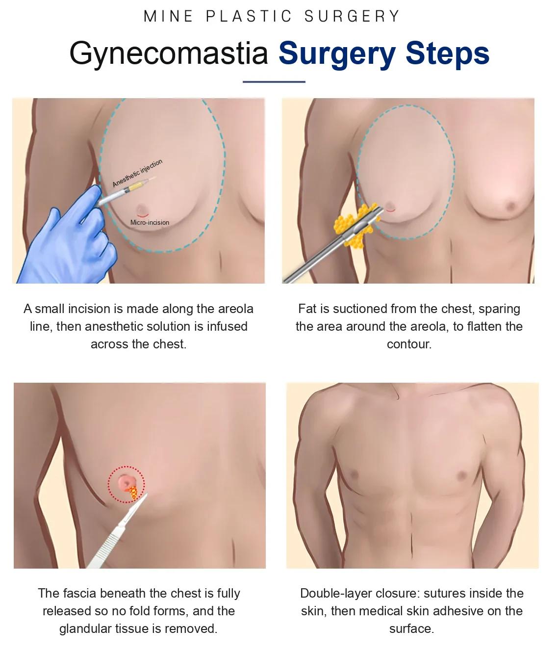 Illustration of MINE gynecomastia surgery steps — areolar micro-incision, liposuction, gland removal and double-layer closure, planned to place gynecomastia surgery scars at the areola edge