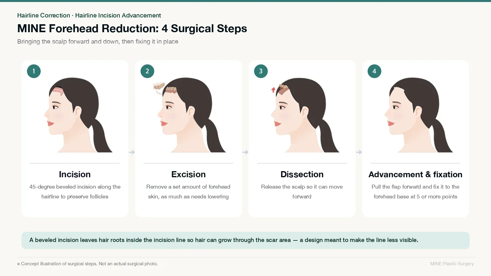Hairline lowering vs hair transplant guide: four-step concept illustration of hairline incision advancement — incision, forehead skin excision, scalp release, and advancement with fixation
