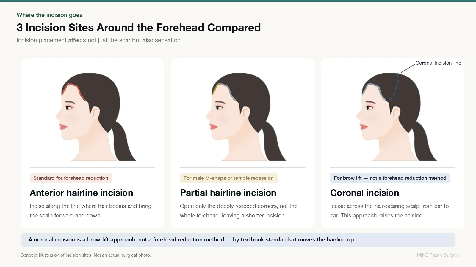Hairline lowering vs hair transplant guide: concept illustration comparing three forehead incision sites — anterior hairline incision, partial temple incision, and a coronal incision that raises the hairline