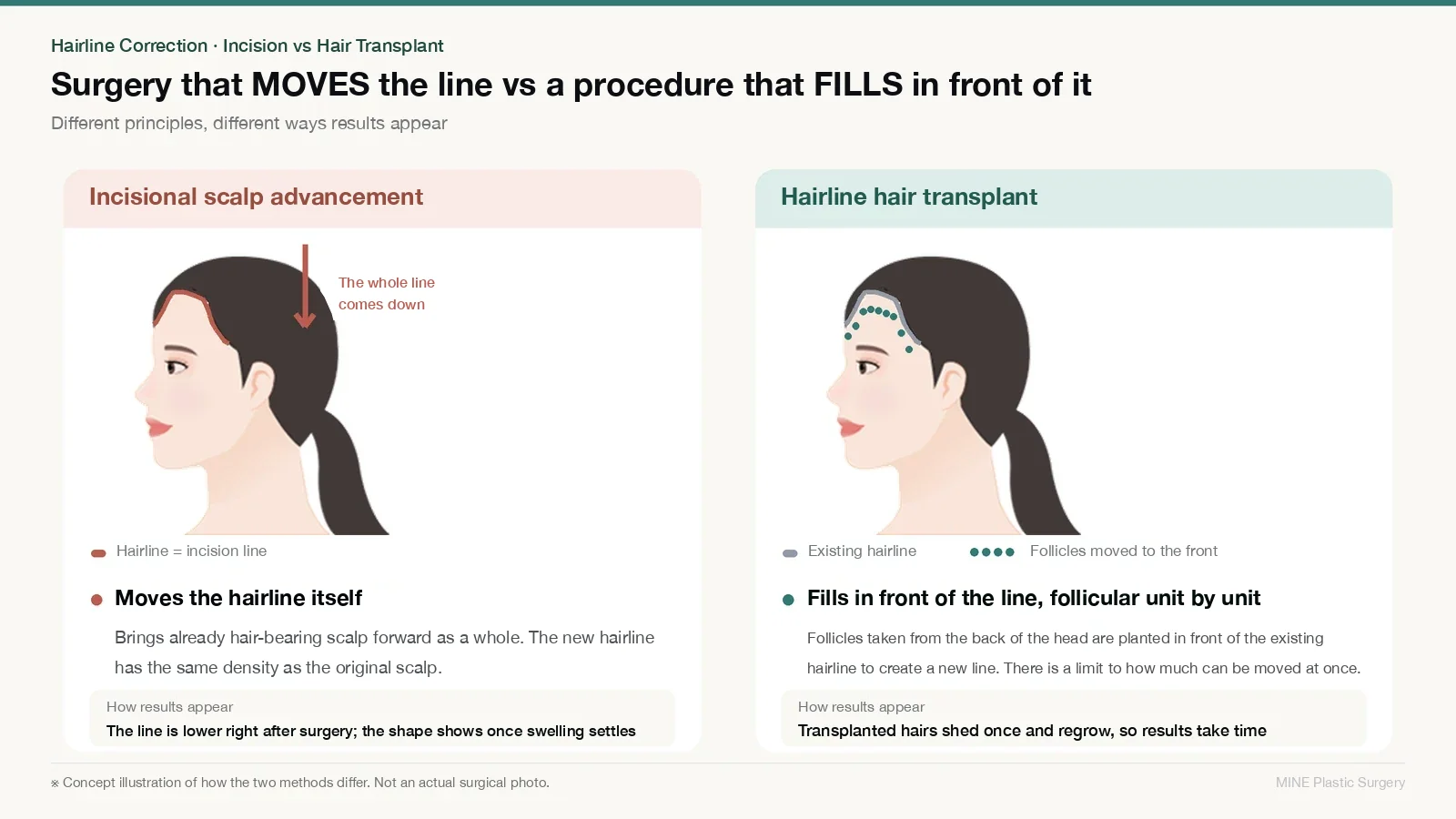 Hairline lowering vs hair transplant concept diagram: scalp advancement moves the whole line down, while a transplant fills in front of it with follicles