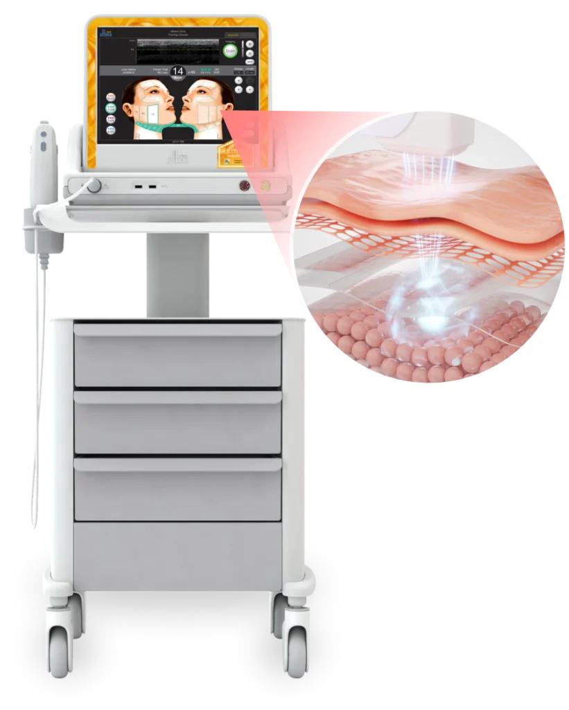 Ulthera device with DeepSEE imaging screen used to plan how many Ultherapy shots each area needs