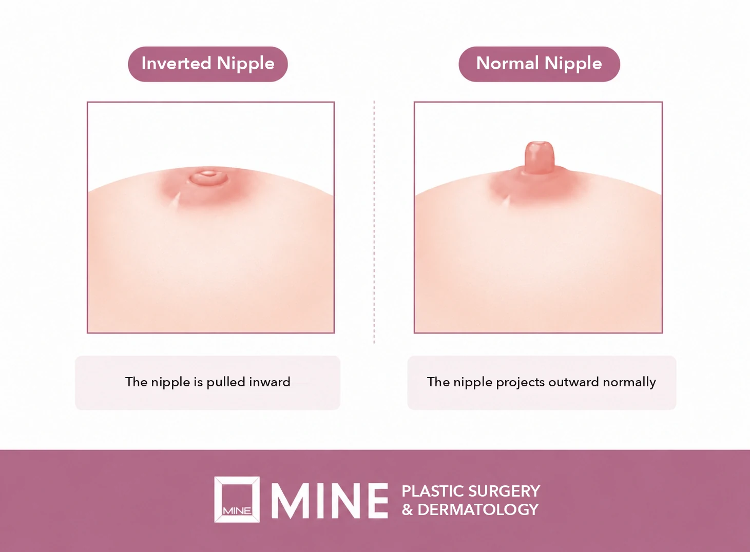 Illustration comparing an inverted nipple pulled inward with a normal projecting nipple, showing the shape that inverted nipple recurrence returns to