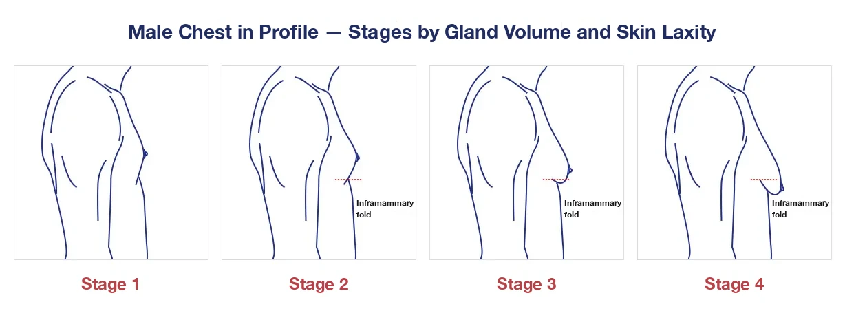 Male chest in profile: gynecomastia stages 1 to 4 by gland volume and skin laxity (diagram)