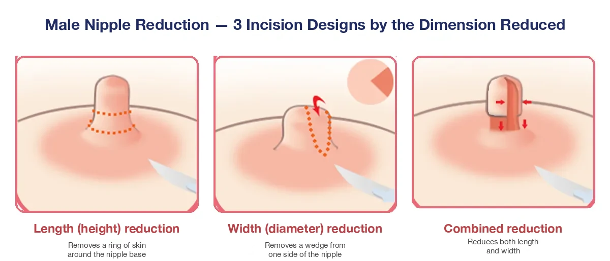 Male nipple reduction: 3 incision designs by dimension — height reduction, width reduction, and combined reduction (diagram)
