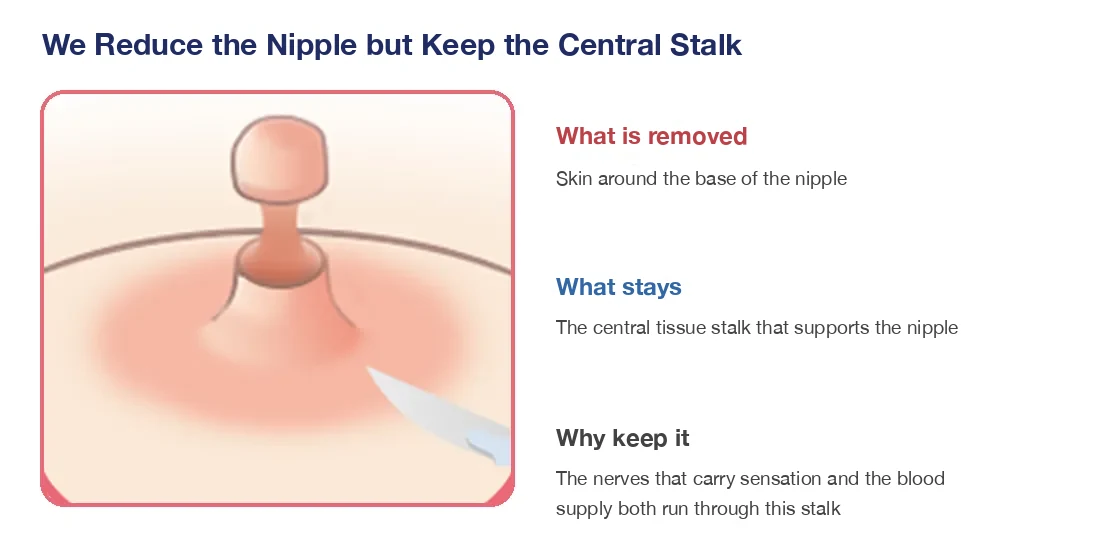 Diagram showing that nipple reduction keeps the central tissue stalk that carries the nerves and blood supply to the nipple
