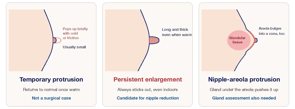 The 3 causes to rule out before male nipple reduction: temporary protrusion, persistent nipple enlargement, and nipple-areola protrusion caused by glandular tissue (side-view diagram)